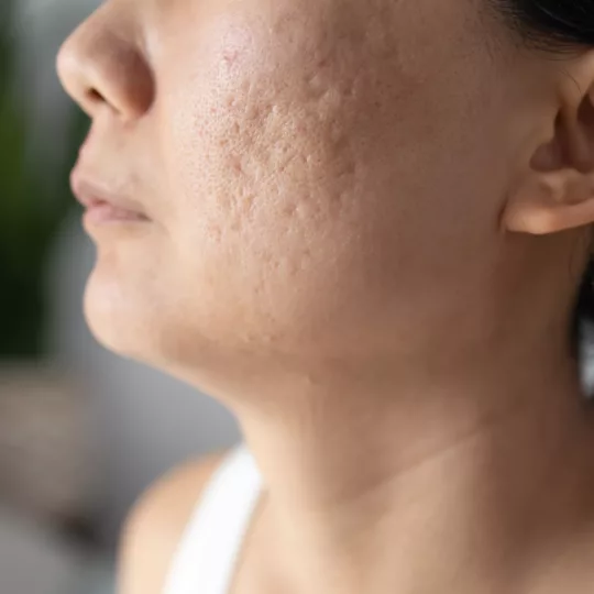 Microneedling in Novi | Heal Stretch Marks & Acne