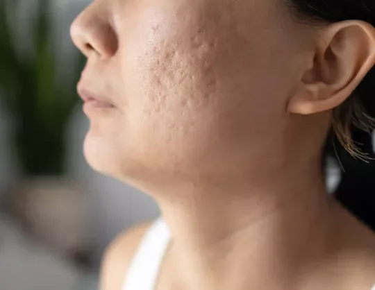 Microneedling treatment in Novi, MI