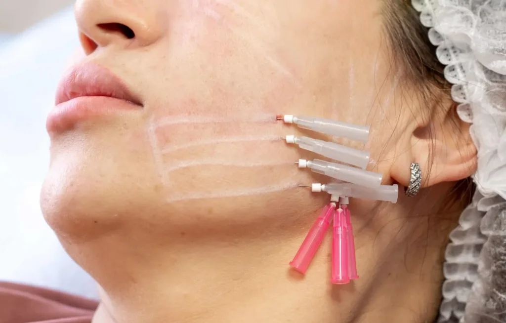 A close-up of a woman undergoing PDO threads treatment in Novi MI, with multiple threads inserted in the cheek area to lift and tighten sagging skin.