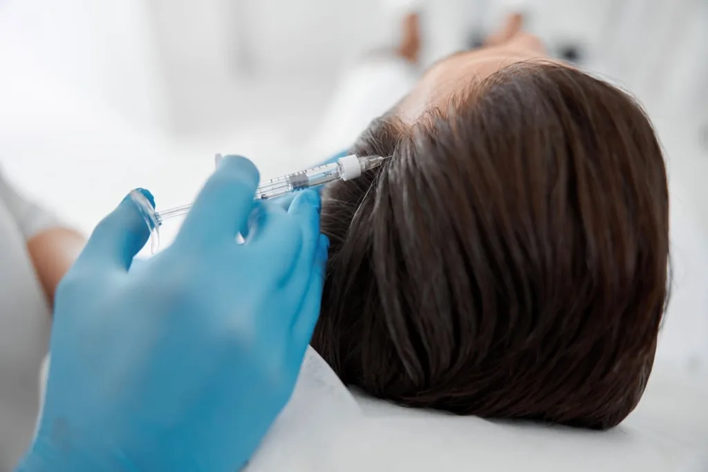 A specialist performing PRP injections for hair on a patient’s scalp to stimulate natural hair growth and improve follicle health.